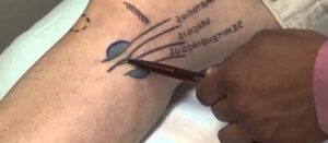 como se cura la tendinitis